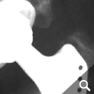 Osteolyse um einen Prothesenschaft (Pfeile) Osteolyse um einen Prothesenschaft (Pfeile)